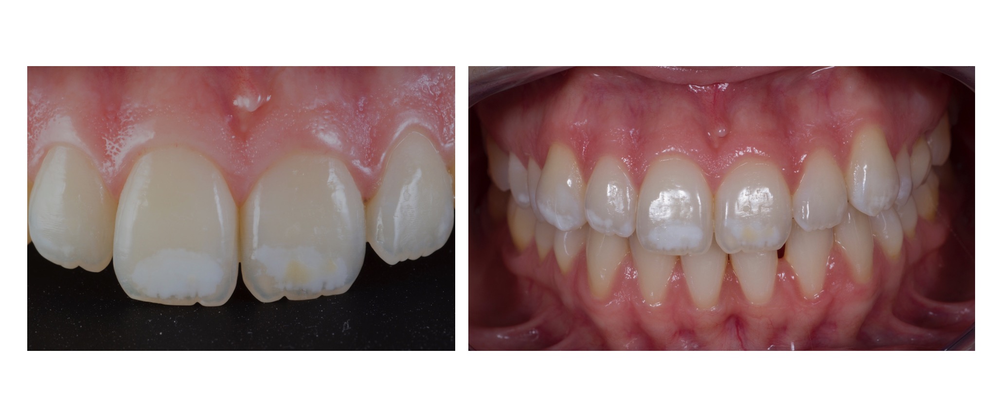 érosion-infiltration